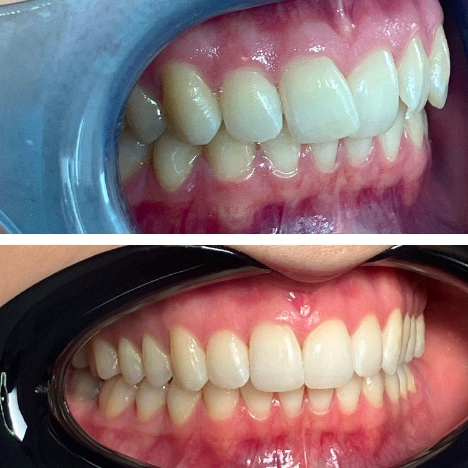 Invisalign before and after case 2