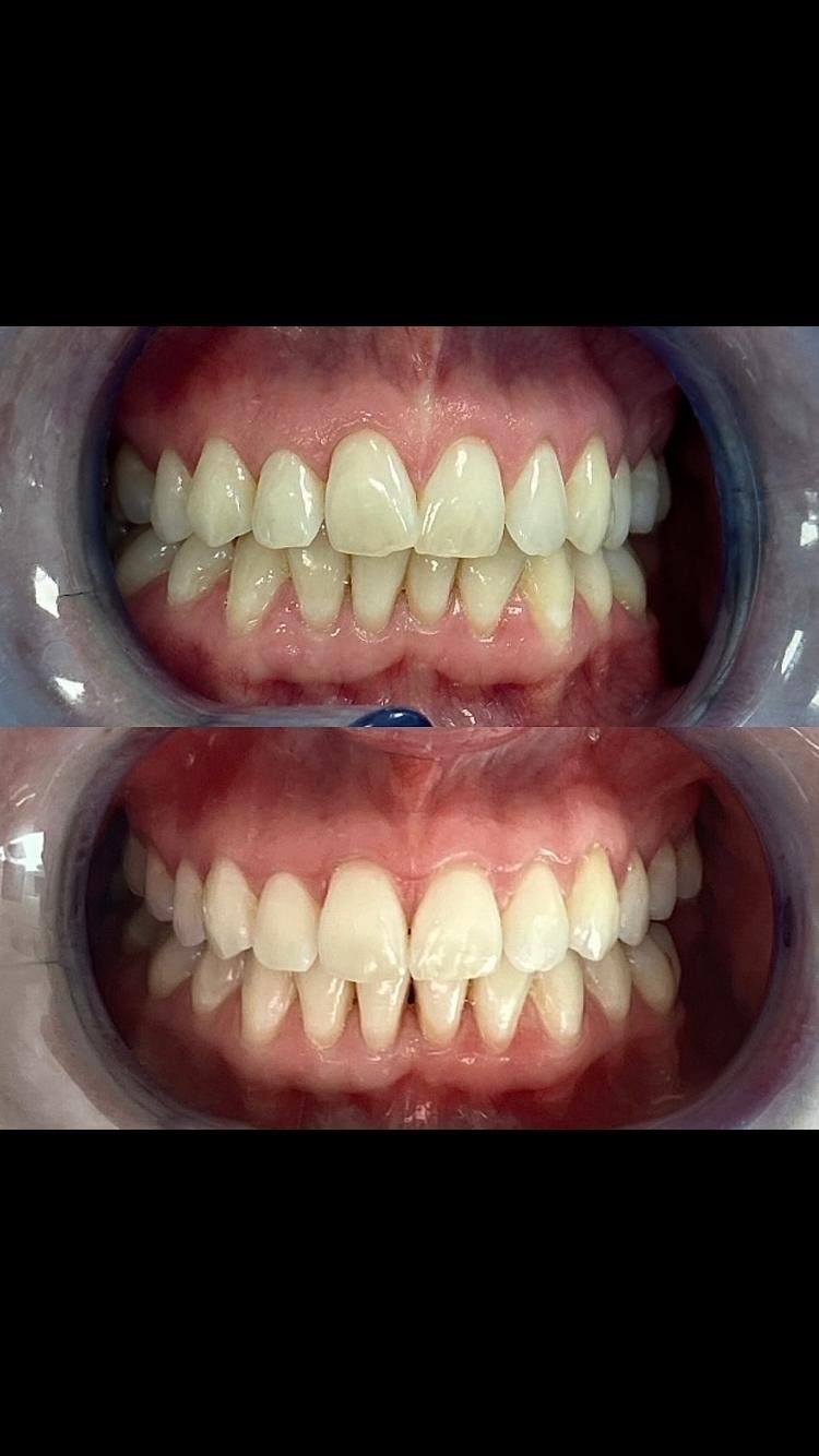 Invisalign before and after case 5