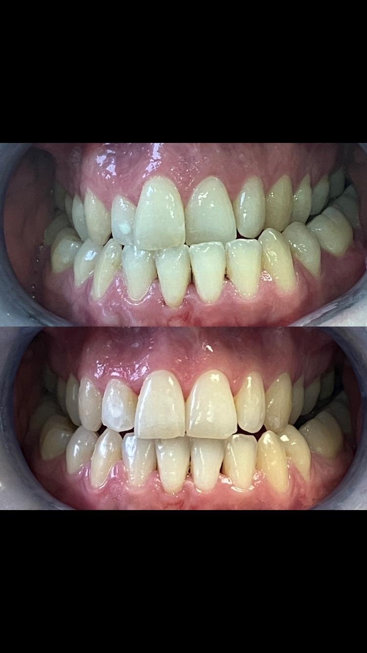 Invisalign before and after case 7