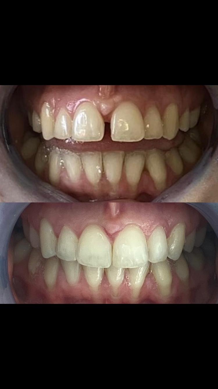 Invisalign before and after case 8